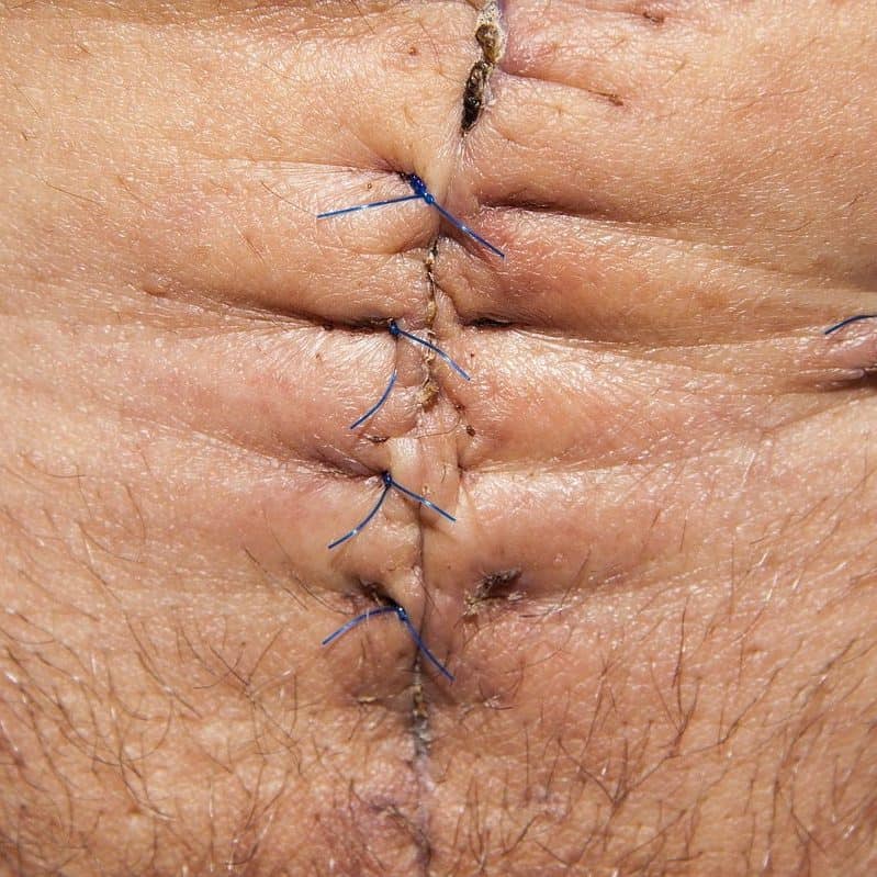 op, operation, abdomen surgery-103061.jpg